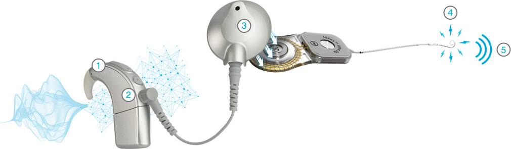 Esquema do implante coclear com cinco pontos numerados: 1 microfone, 2 processador de som, 3 antena, 4 feixe de eletrodos no ouvido interno e 5 nervo auditivo